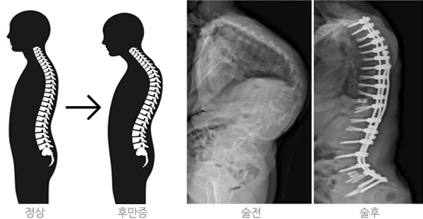 척추후만증